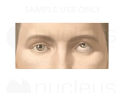 Appearance of Strabismus (Impaired Up, Down Movement)