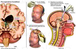 Surgical Removal of Third Ventricle Lesion

