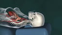 Cervical Chiropractic Adjustment with Tearing of Vertebral Artery Wall and Resulting Stroke