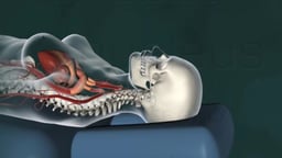 Cervical Chiropractic Adjustment with Tearing of Vertebral Artery Wall and Resulting Stroke