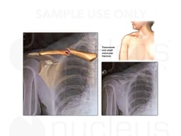 Right Clavicular Fracture