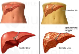 Normal Liver Anatomy Versus Stage Four Cirrhosis of Liver