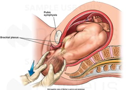 Mechanism of Shoulder Dystocia