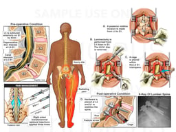 Lumbar Spine Injury with Epidural Steroid Injections and Eventual Surgical Decompression and Fusion