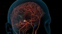 Stroke (Abbreviated Version)