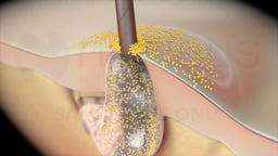 Bacterial Infiltration of a Clogged Hair Follicle