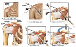 Post-accident Right Shoulder Rotator Cuff Injuries with Arthroscopic Repair