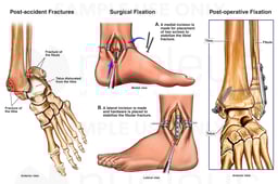 Left Bimalleolar Ankle Fractures with Subsequent Surgical Fixation