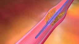 Blocked Coronary Artery with Balloon Angioplasty and Stent Repair