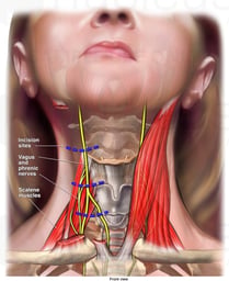 Neck Nerve Damage