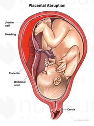 Placental Abruption