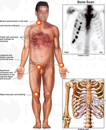 Male Figure with Rib Fractures Secondary to Motor Vehicle Accident (MVA)