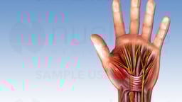 Carpal Tunnel Syndrome with Surgical Release
