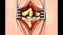 Back Surgery - Lumbar Laminectomy