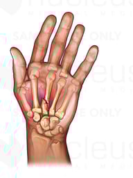 Third Metacarpal Fracture