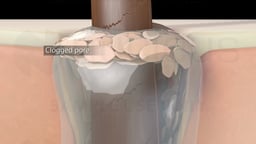 Clogged Hair Follicle with Pore Labeled