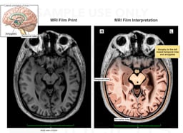 Traumatic Brain Injury