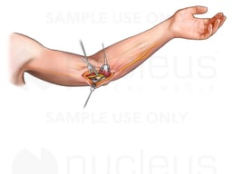 Ulnar Nerve Transposition