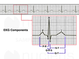 EKG / ECG Strip Components (QRS Complex)