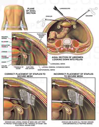 Laparoscopic Inguinal Hernia Repair with Inappropriate Staple Placement