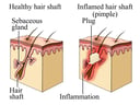 Pimple (Acne) - Normal vs Inflamed Hair Shaft