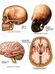 Traumatic Injury of the Skull and Brain