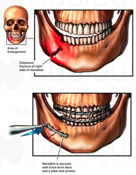 Displaced Fracture and Fixation of the Jaw