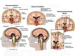 Brain Surgery - Intracerebral Tumor with Blockage of CSF Circulation