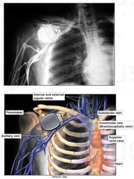 Venogram