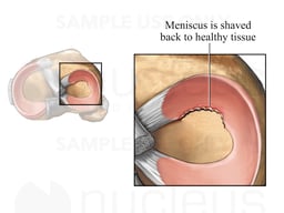 Shaved Meniscus