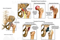 Possible Future Conditions and Surgeries of Right Hip Joint After Trauma