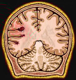 Brain with Cerebral Trauma (MRI), Cut-away View