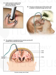 Placement of Intracranial Pressure Monitor (ICP)