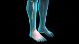 Complex Regional Pain Syndrome (CRPS)/Reflex Sympathetic Dystrophy (RSD)