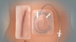 Dispositivo de bomba para el dolor