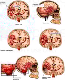 Progression of Cerebral Injury