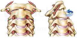 Rotational Injury of the Vertebral Artery