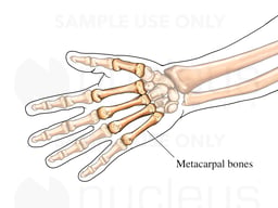 The Metacarpal Bones