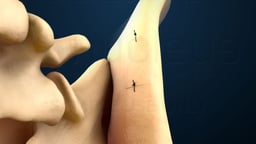 Lumbar Spinal Fusion