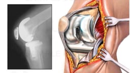 Total Knee Joint Replacement Surgery