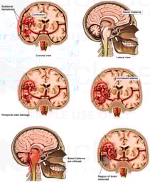 Progression of Cerebral Injury