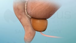 Understanding Prostate Cancer