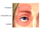 Glaucoma: Areas of Pain