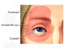 Glaucoma: Areas of Pain