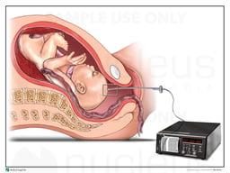Fetal Monitoring: Intracranial Device