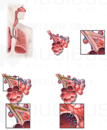 Chronic Bronchitis