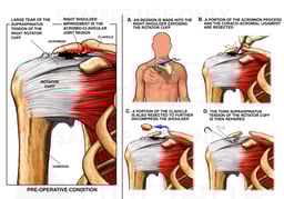 Right Shoulder Impingement and Rotator Cuff Tear with Surgical Repair