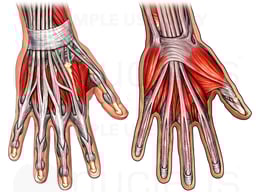 Third Metacarpal Fracture