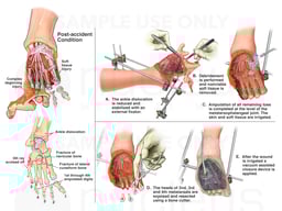 Surgical Repairs of Right Foot