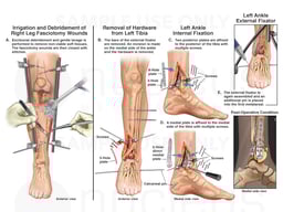 Surgical Procedures on the Legs